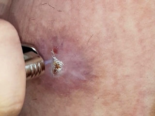 burning the tit skin